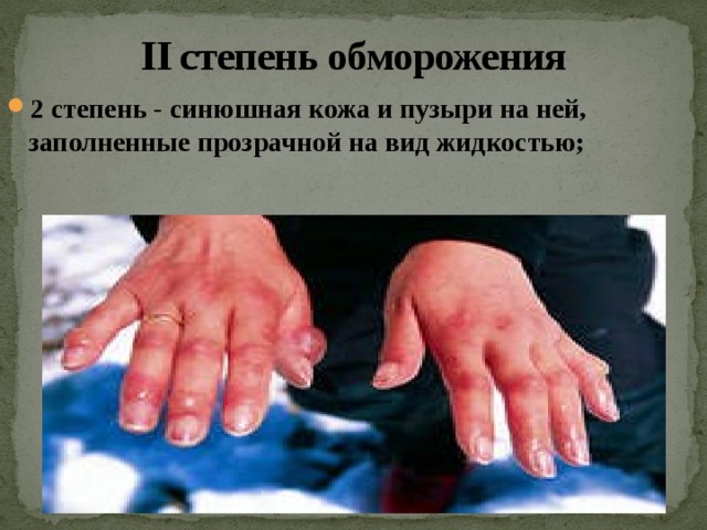 II степень обморожения 2 степень - синюшная кожа и пузыри на ней, заполненные прозрачной на вид жидкостью;   