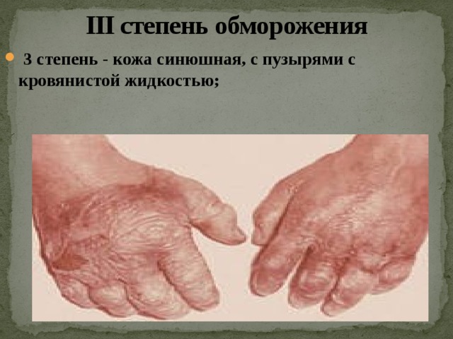 III степень обморожения   3 степень - кожа синюшная, с пузырями с кровянистой жидкостью;  