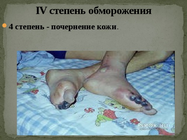 IV степень обморожения 4 степень - почернение кожи . 