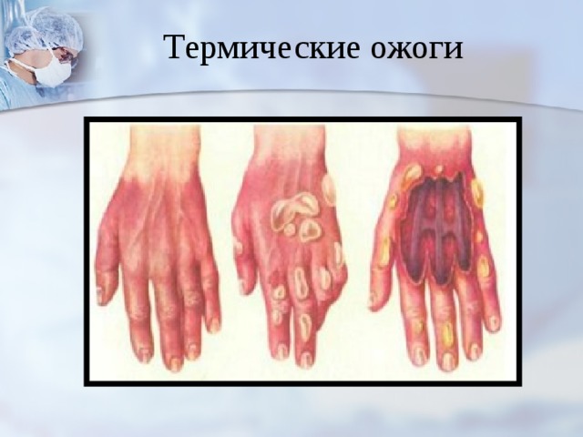 Термические ожоги 