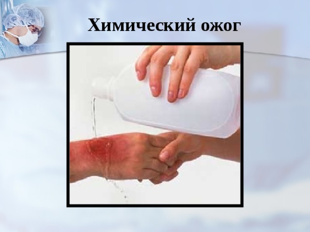 Химический ожог   