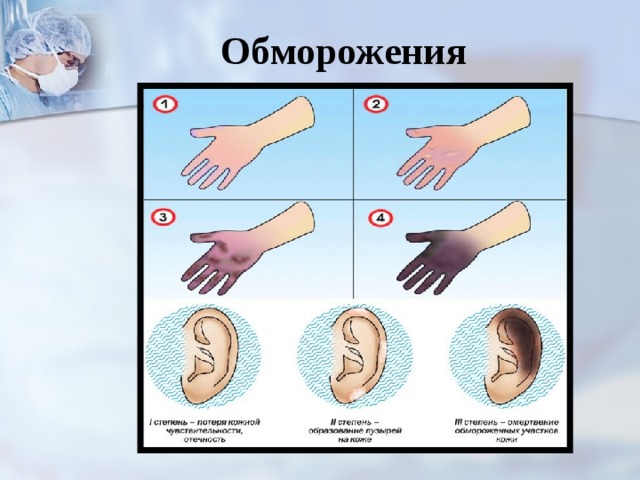 Обморожения 