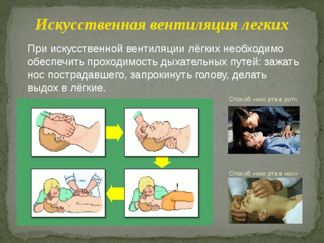 Искусственная вентиляция легких При искусственной вентиляции лёгких необходимо обеспечить проходимость дыхательных путей: зажать нос пострадавшего, запрокинуть голову, делать выдох в лёгкие. Способ «изо рта в рот» Способ «изо рта в нос» 