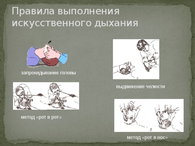 Правила выполнения искусственного дыхания запрокидывание головы выдвижение челюсти метод «рот в рот» метод «рот в нос» 
