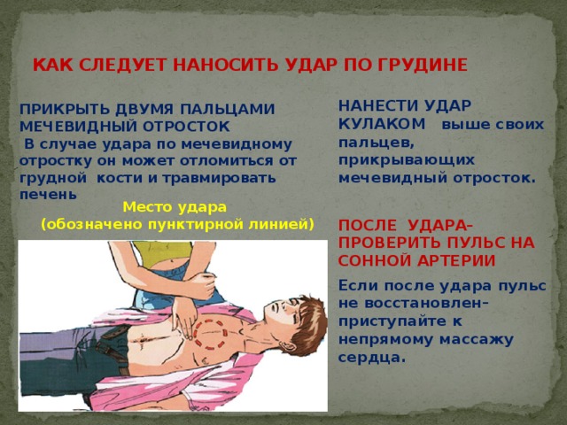 КАК СЛЕДУЕТ НАНОСИТЬ УДАР ПО ГРУДИНЕ   НАНЕСТИ УДАР КУЛАКОМ выше своих пальцев, прикрывающих мечевидный отросток.  ПОСЛЕ УДАРА–ПРОВЕРИТЬ ПУЛЬС НА СОННОЙ АРТЕРИИ Если после удара пульс не восстановлен– приступайте к непрямому массажу сердца.   ПРИКРЫТЬ ДВУМЯ ПАЛЬЦАМИ МЕЧЕВИДНЫЙ ОТРОСТОК   В случае удара по мечевидному отростку он может отломиться от грудной кости и травмировать печень Место удара (обозначено пунктирной линией) 