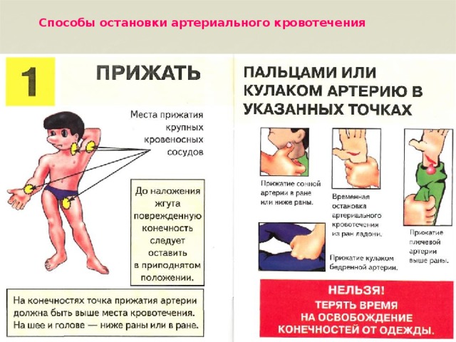 Способы остановки артериального кровотечения 