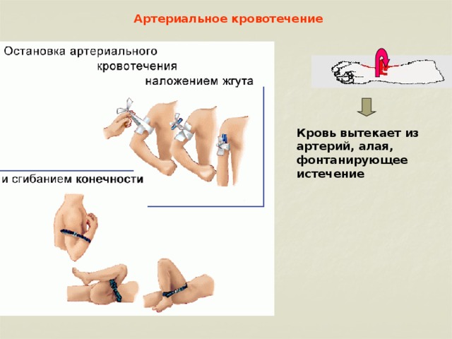 Артериальное кровотечение Кровь вытекает из артерий, алая, фонтанирующее истечение  