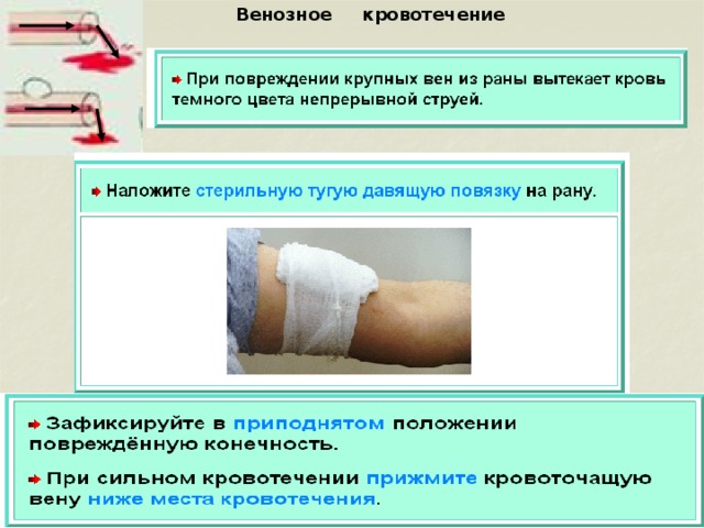  Венозное кровотечение 