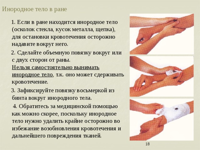 Инородное тело в ране  1. Если в ране находится инородное тело (осколок стекла, кусок металла, щепка), для остановки кровотечения осторожно надавите вокруг него.  2. Сделайте объемную повязку вокруг или с двух сторон от раны. Нельзя самостоятельно вынимать инородное тело , т.к. оно может  сдерживать кровотечение.  3. Зафиксируйте повязку восьмеркой из бинта вокруг инородного тела.  4. Обратитесь за медицинской помощью как можно скорее, поскольку инородное тело нужно удалить крайне осторожно во избежание возобновления кровотечения и дальнейшего повреждения тканей.  