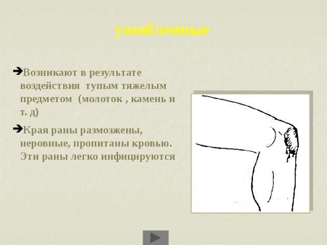 ушибленные Возникают в результате воздействия тупым тяжелым предметом (молоток , камень и т. д) Края раны размозжены, неровные, пропитаны кровью. Эти раны легко инфицируются 
