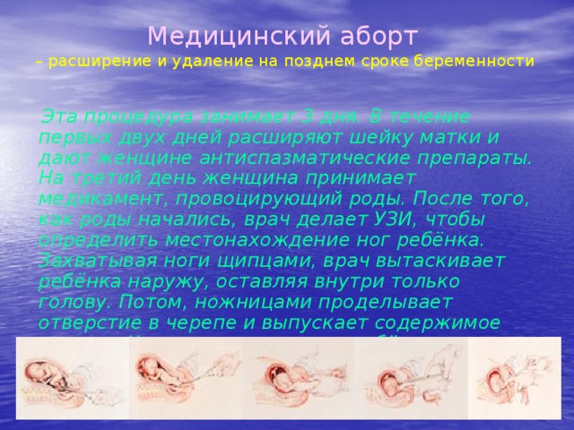 Медицинский аборт   – расширение и удаление на позднем сроке беременности  Эта процедура занимает 3 дня. В течение первых двух дней расширяют шейку матки и дают женщине антиспазматические препараты. На третий день женщина принимает медикамент, провоцирующий роды. После того, как роды начались, врач делает УЗИ, чтобы определить местонахождение ног ребёнка. Захватывая ноги щипцами, врач вытаскивает ребёнка наружу, оставляя внутри только голову. Потом, ножницами проделывает отверстие в черепе и выпускает содержимое наружу. Череп разрушается и ребёнка извлекают из матки полностью. 