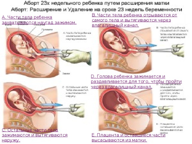 В. Части тела ребенка отрываются от самого тела и вытягиваются через влагалищный канал.    А. Части тела ребенка захватываются наугад зажимом.  D. Голова ребенка зажимается и раздавливается для того, чтобы пройти через влагалищный канал.    С. Остальные части тела зажимаются и вытягиваются наружу.    E. Плацента и оставшиеся части высасываются из матки. 