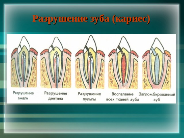 Разрушение зуба (кариес) 