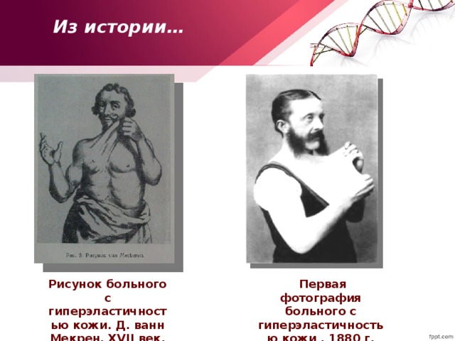 Из истории… Рисунок больного с гиперэластичностью кожи. Д. ванн Мекрен. XVII век.  Первая фотография больного с гиперэластичностью кожи . 1880 г.