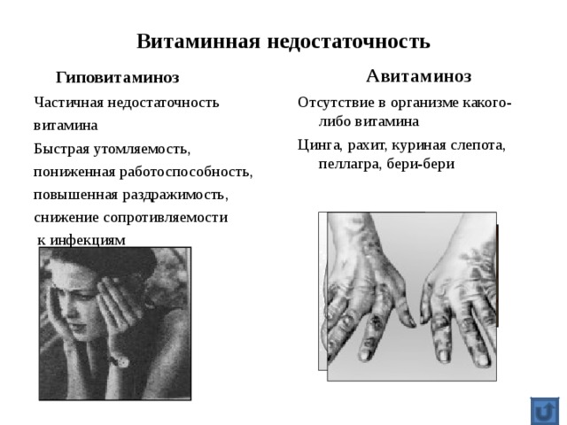 Витаминная недостаточность  Авитаминоз  Гиповитаминоз Частичная недостаточность витамина Быстрая утомляемость, пониженная работоспособность, повышенная раздражимость, снижение сопротивляемости  к инфекциям Отсутствие в организме какого-либо витамина Цинга, рахит, куриная слепота, пеллагра, бери-бери 