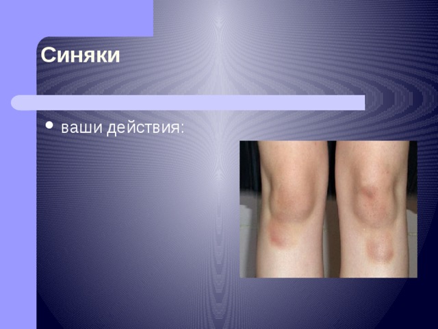 Синяки ваши действия: 