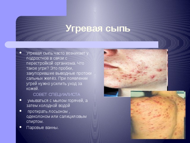 Угревая сыпь Угревая сыпь часто возникает у подростков в связи с перестройкой организма. Что такое угри? Это пробки, закупорившие выводные протоки сальных желёз. При появлении угрей нужно усилить уход за кожей. СОВЕТ СПЕЦИАЛИСТА  умываться с мылом горячей, а затем холодной водой  протирать лосьоном , одеколоном или салициловым спиртом. Паровые ванны. 