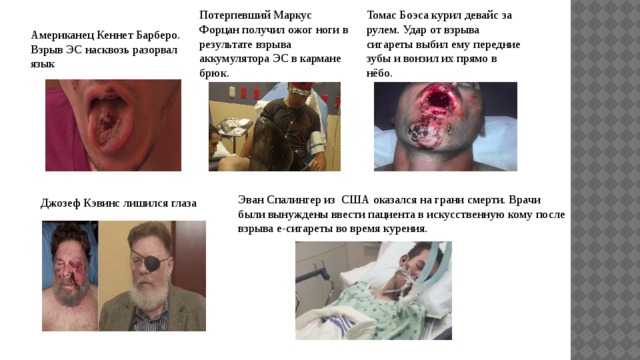 Потерпевший Маркус Форцан получил ожог ноги в результате взрыва аккумулятора ЭС в кармане брюк. Томас Боэса курил девайс за рулем. Удар от взрыва сигареты выбил ему передние зубы и вонзил их прямо в нёбо. Американец Кеннет Барберо. Взрыв ЭС насквозь разорвал язык Эван Спалингер из США оказался на грани смерти. Врачи были вынуждены ввести пациента в искусственную кому после взрыва е-сигареты во время курения. Джозеф Кэвинс лишился глаза 