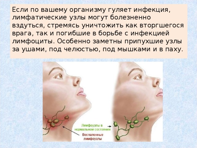 Если по вашему организму гуляет инфекция, лимфатические узлы могут болезненно вздуться, стремясь уничтожить как вторгшегося врага, так и погибшие в борьбе с инфекцией лимфоциты. Особенно заметны припухшие узлы за ушами, под челюстью, под мышками и в паху.   