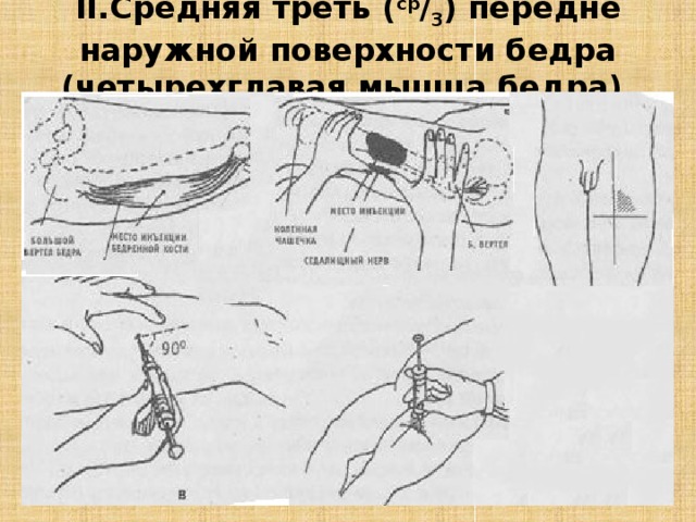 II.Средняя треть ( ср / 3 ) передне наружной поверхности бедра (четырехглавая мышца бедра).   