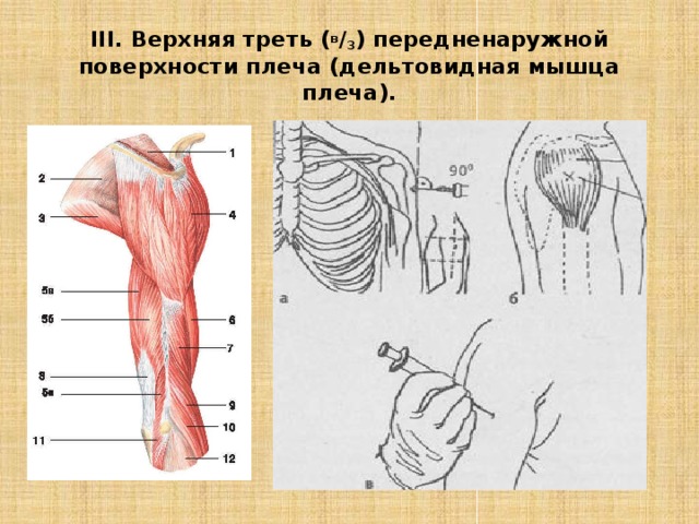 III. Верхняя треть ( в / 3 ) передненаружной поверхности плеча (дельтовидная мышца плеча). 