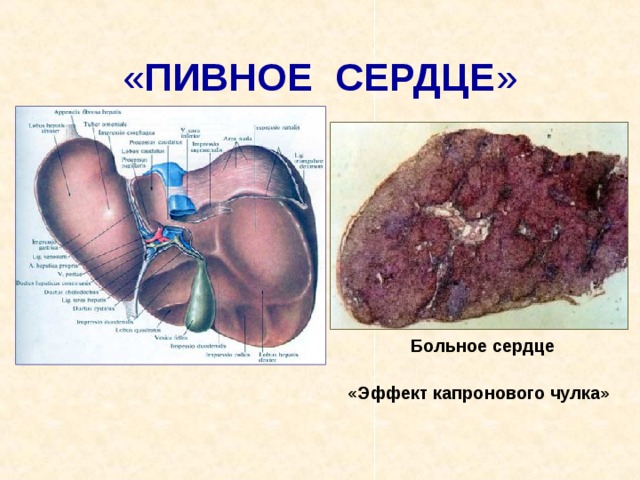 « ПИВНОЕ СЕРДЦЕ » Больное сердце  «Эффект капронового чулка» 