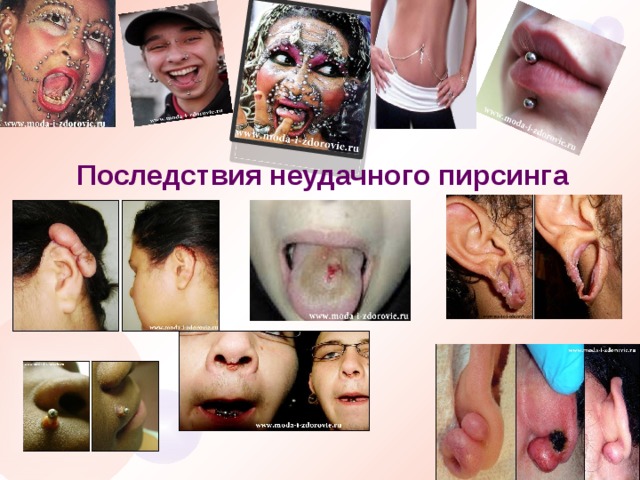 Последствия неудачного пирсинга 