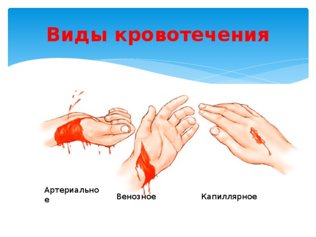 Виды кровотечения Артериальное Венозное Капиллярное 