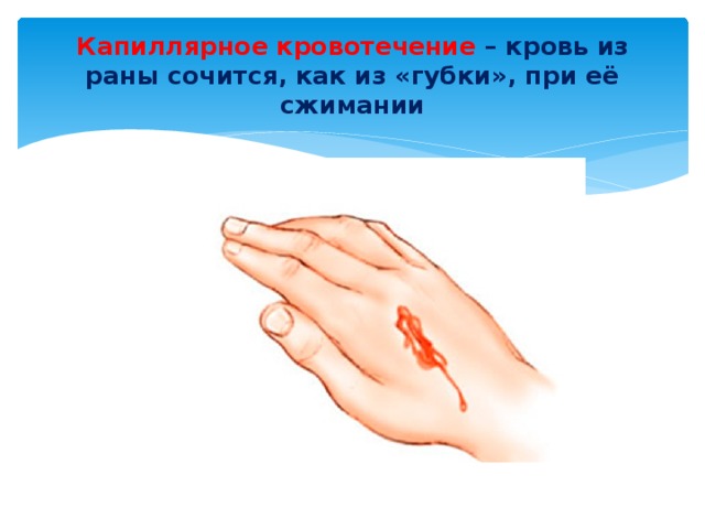 Капиллярное кровотечение – кровь из раны сочится, как из «губки», при её сжимании 