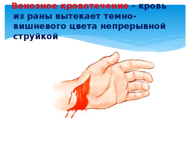 Венозное кровотечение - кровь из раны вытекает темно-вишневого цвета непрерывной струйкой   