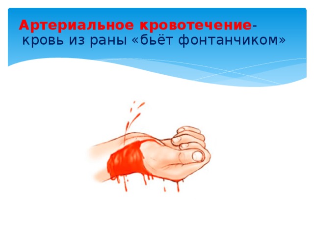 Артериальное  кровотечение - кровь из раны «бьёт фонтанчиком»   