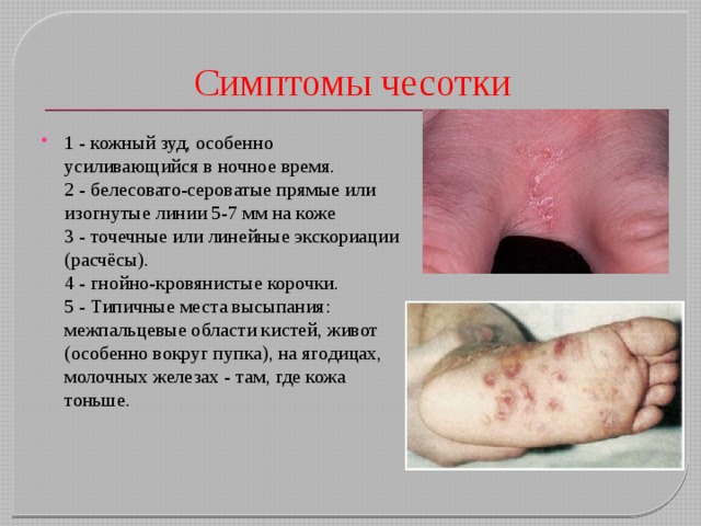 Симптомы чесотки 1 - кожный зуд, особенно усиливающийся в ночное время.  2 - белесовато-сероватые прямые или изогнутые линии 5-7 мм на коже    3 - точечные или линейные экскориации (расчёсы).   4 - гнойно-кровянистые корочки.   5 - Типичные места высыпания: межпальцевые области кистей, живот (особенно вокруг пупка), на ягодицах, молочных железах - там, где кожа тоньше. 