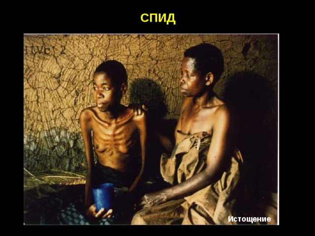 СПИД Истощение 