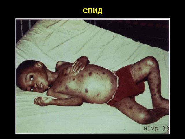 СПИД 