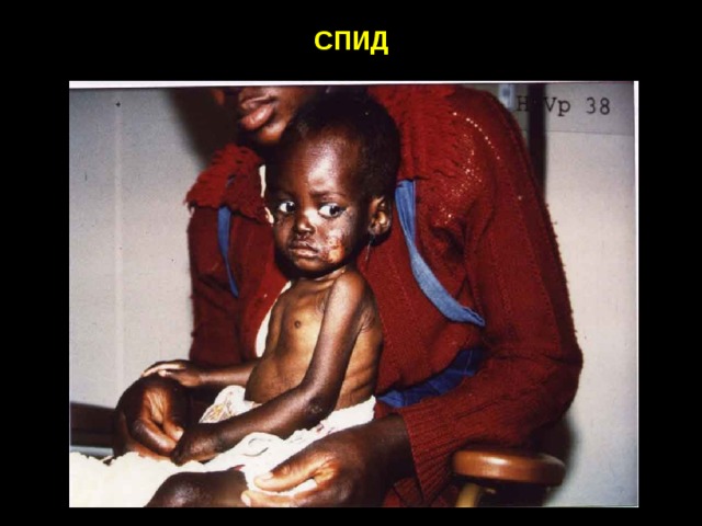 СПИД 
