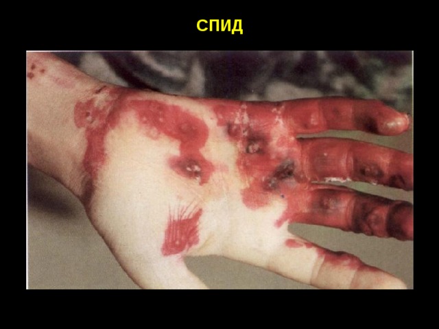 СПИД 