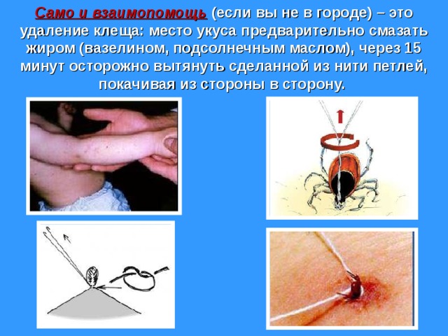 Само и взаимопомощь (если вы не в городе) – это удаление клеща: место укуса предварительно смазать жиром (вазелином, подсолнечным маслом), через 15 минут осторожно вытянуть сделанной из нити петлей, покачивая из стороны в сторону. 