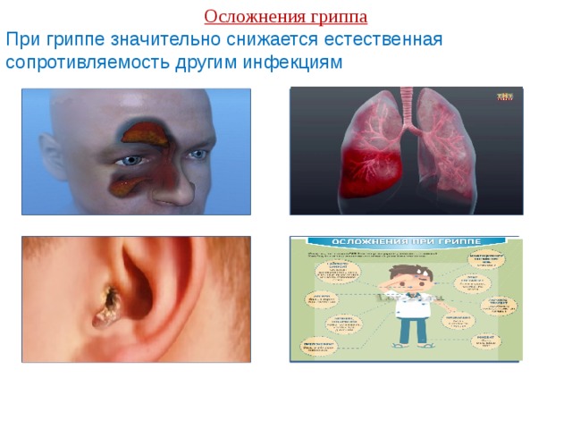 Осложнения гриппа При гриппе значительно снижается естественная сопротивляемость другим инфекциям 