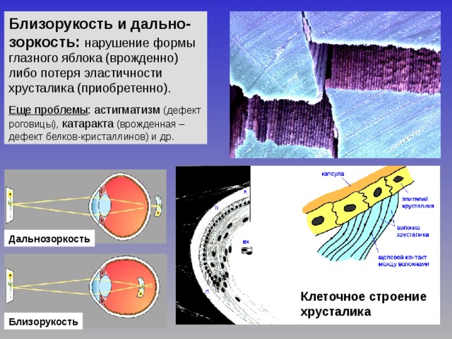 Близорукость и дально-зоркость: нарушение формы глазного яблока (врожденно) либо потеря эластичности хрусталика (приобретенно). Еще проблемы : астигматизм (дефект роговицы), катаракта (врожденная – дефект белков-кристаллинов) и др. Дальнозоркость Клеточное строение хрусталика Близорукость 