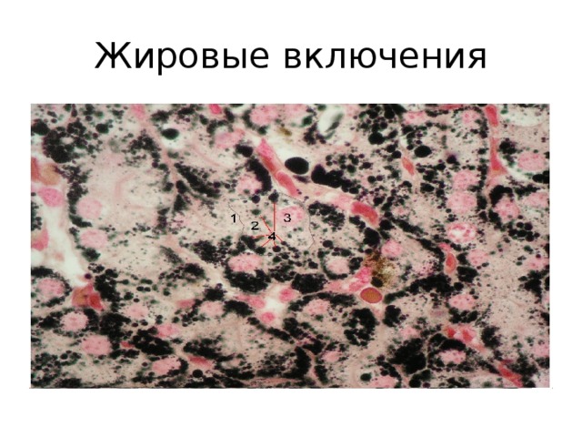 Жировые включения 