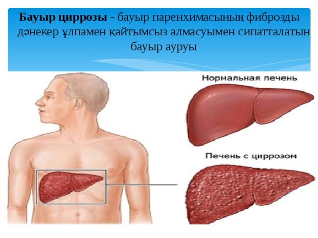 Бауыр циррозы  - бауыр паренхимасының фиброзды дәнекер ұлпамен қайтымсыз алмасуымен сипатталатын бауыр ауруы 