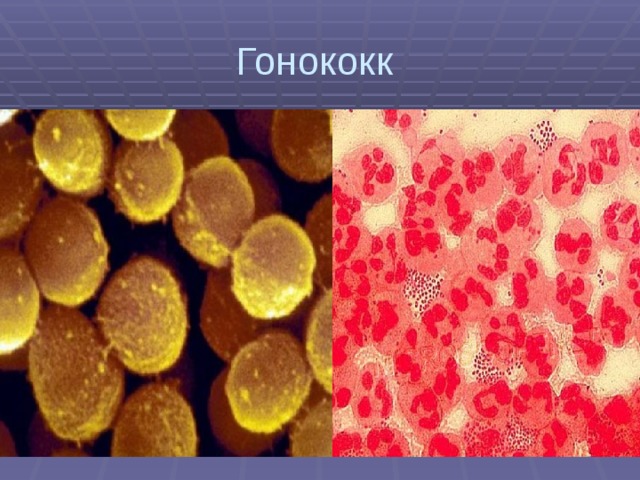 Гонококк 