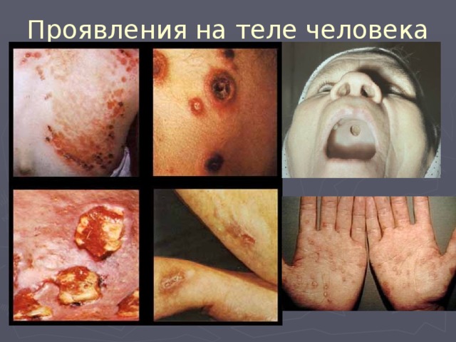 Проявления на теле человека 