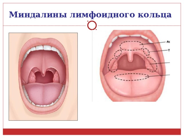 Миндалины лимфоидного кольца 