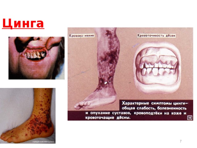  Цинга  