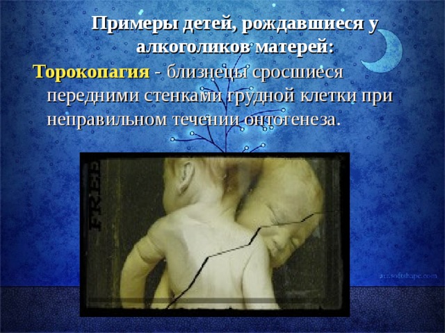 Примеры детей, рождавшиеся у алкоголиков матерей: Торокопагия - близнецы сросшиеся передними стенками грудной клетки при неправильном течении онтогенеза . 