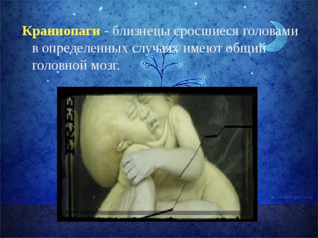  Краниопаги - близнецы сросшиеся головами в определенных случаях имеют общий головной мозг. 