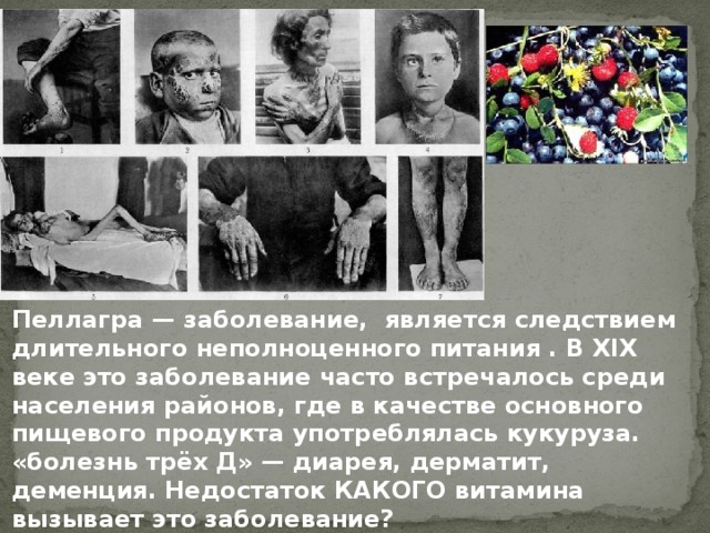 Пеллагра — заболевание, является следствием длительного неполноценного питания . В XIX веке это заболевание часто встречалось среди населения районов, где в качестве основного пищевого продукта употреблялась кукуруза. «болезнь трёх Д» — диарея, дерматит, деменция. Недостаток КАКОГО витамина вызывает это заболевание?          