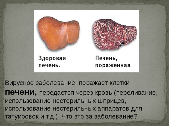 Вирусное заболевание, поражает клетки печени, передается через кровь (переливание, использование нестерильных шприцев, использование нестерильных аппаратов для татуировок и т.д.). Что это за заболевание? 