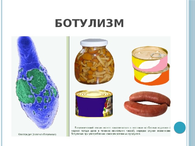 Ботулизм 